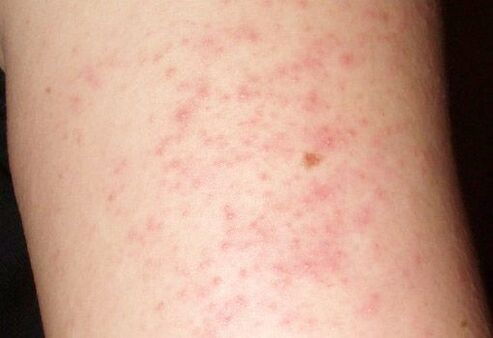 Itchy skin rash - a sign of the presence of worms in the liver
