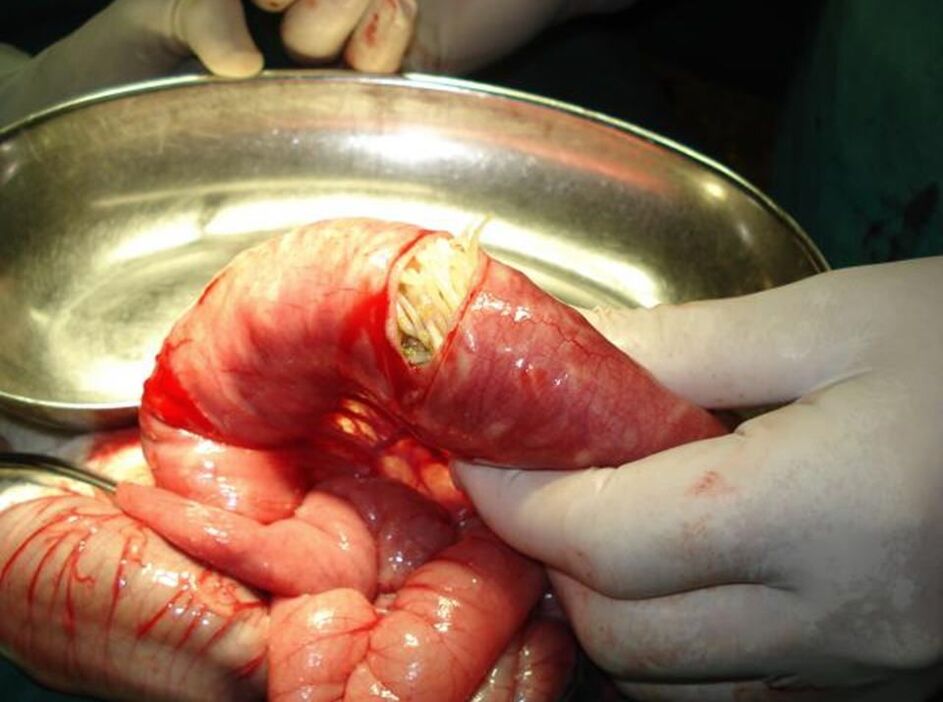 Roundworms in human intestines